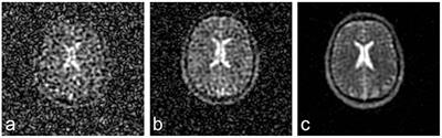 Potential of Sodium MRI as a Biomarker for Neurodegeneration and Neuroinflammation in Multiple Sclerosis